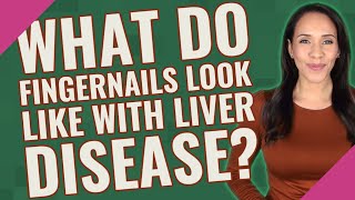 What do fingernails look like with liver disease [upl. by Candace]