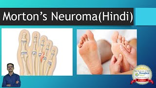 Mortons Neuroma Interdigital Neuroma Hindi Foot Pain and Metatarsalgia [upl. by Tnomad]