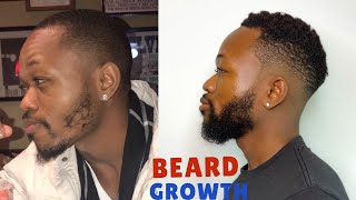 HOW I GREW MY BEARD USING MINOXIDIL  GET RID OF PATCHY BEARD [upl. by Beisel]