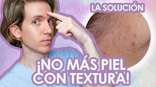 Como ELIMINAR los COMEDONES CERRADOS  Fácil y efectivo  Recomendaciones de un dermatologo [upl. by Savitt95]