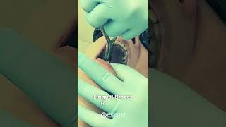 Lingual Braces Removal 😎 [upl. by Grier389]