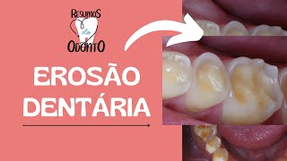 EROSÃO DENTÁRIA  LCNC  Resumos de Odonto [upl. by Htenywg]