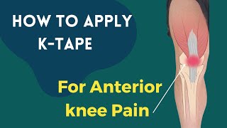 How to treat Knee Pain Patellofemoral Pain syndrome using Kinesiology tape [upl. by Atterrol631]