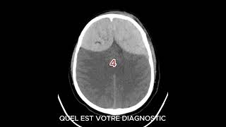 HEMATOME EXTRADURAL AIGU hospital femmemedecine radiologystudent [upl. by Amalburga]