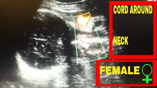 Cord around the neck on ultrasound l IUGR baby l FEMALE l❤❤❤ [upl. by Tneicniv]