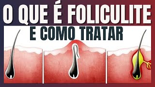 O que é Foliculite e como tratar [upl. by Aredna]