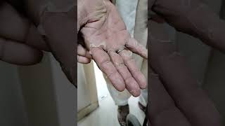 DERMATITIS eczema palm skin peeling exfoliation with itching on bilateral ✋ hospital skincare [upl. by Ioab66]