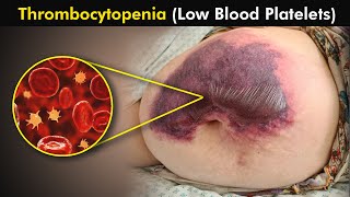 Thrombocytopenia Causes Symptoms and Treatment 3d Animation  low blood platelets [upl. by Negah]