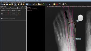 TraumaCad Foot Osteotomies Wizard [upl. by Attemaj565]