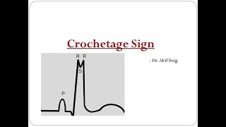 Crochetage sign in ASD  Dr Akif Baig [upl. by Enileda]