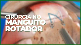 CIRURGIA ARTROSCOPIA DO MANGUITO ROTADOR â€ºâ€º DR RODRIGO PASTORE â€¹â€¹ [upl. by Edgell]