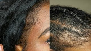 Natural Hair 5 Tips How to REGROW balding or thinning 4C EDGES [upl. by Nicky]