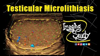 Testicular Microlithiasis  Ultrasound  Case 334 [upl. by Leone286]