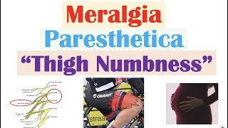 Meralgia Paresthetica “Numbness of the Thigh”  Causes Symptoms Diagnosis Treatment [upl. by Enitsyrhc149]