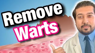 Wart Removal 101  How to Get Rid of Warts [upl. by Franz]