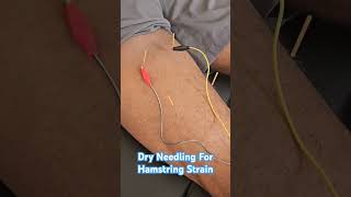 Dry needling for hamstring strain dryneedling physicaltherapy fuelyourlife [upl. by Jedlicka840]