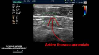 PEC BLOCK ET LOCALISATION DE LARTERE THORACO ACROMIALE [upl. by Browne]