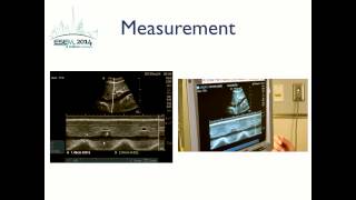 Inferior Vena Cava Ultrasound [upl. by Esiuol17]