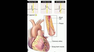 STEMI VS NSTEMI MEDICOS [upl. by Robillard]