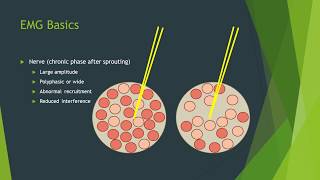 Neuropathy vs myopathy on EMG [upl. by Decima]