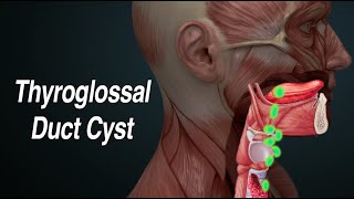 Thyroglossal Duct Cyst Midline Neck Mass [upl. by Edmon767]