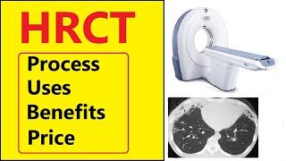 HRCT test information in hindi  Highresolution computed tomography HRCT  HRCT test procedure [upl. by Beaner888]