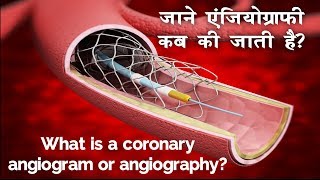 दिल की नसों का हाल जानने के लिए किया जाने वाल टेस्ट एंजियोग्राफी  Angiography in Hindi [upl. by Betti]