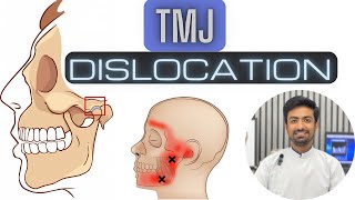 TMJ Dislocation and Management [upl. by Quent]