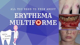 ERYTHEMA MULTIFORME CLINICAL PRESENTATIONTYPESDIAGNOSISTREATMENT ANIMATED ORAL PATHOLOGY NOTES [upl. by Certie269]