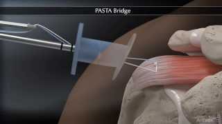 PASTA Bridge Animation [upl. by Arved]