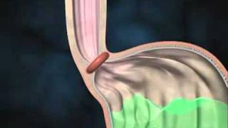 Acid Reflux Disease Causes and Symptoms [upl. by Neibaf]