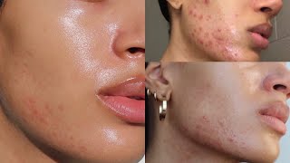 how i cleared my adult hormonal acne breakouts for good [upl. by Swayne331]