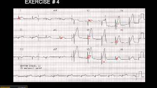 1215 Lead ECG Exercise  4 [upl. by Eico]