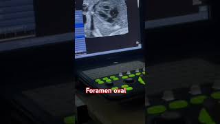 Tabique interventricular y foramen oval [upl. by Navannod577]