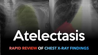 Atelectasis Rapid Review of Chest Xrays [upl. by Nywde]