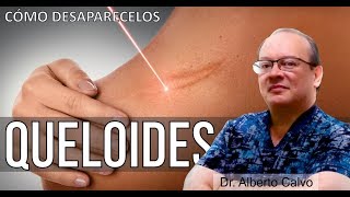 Cómo DESAPARECER las DESAGRADABLES CICATRICES QUELOIDES 🙂 Dr ALBERTO CALVO QUIROZ [upl. by Longwood]