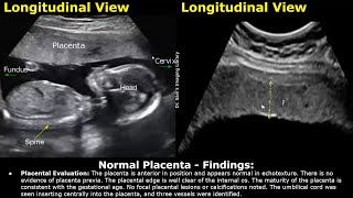 Placenta Ultrasound Reporting  How To Write Pregnancy USG Reports  Pathologies amp Positions Scans [upl. by Gilba150]