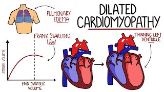 Dilated Cardiomyopathy Made Easy DCM [upl. by Jammie189]