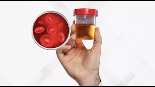 Isolated Hematuria  Definition Causes Evaluation and Management [upl. by Hubing155]