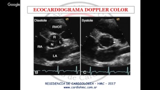 Estenosis pulmonar [upl. by Eecyal]