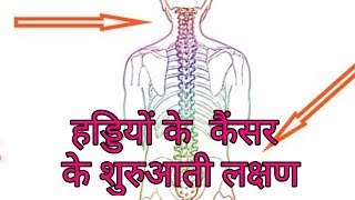 हड्डियों के कैंसर के लक्षणhaddi ke cancer ke lakshanbone cancer symptoms hindi [upl. by Wilmette]