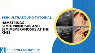 Hamstring ultrasound  Semimembranosus and Semitendinosus tendons and using Anistropy [upl. by Alyl]