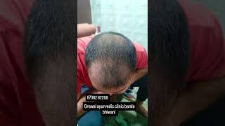 Hair treatment in our patient haircare hairgrowth hairfall hairtreatment alopedand ganjapan [upl. by Menon]