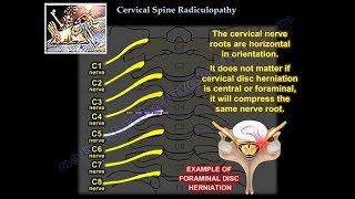 Cervical Radiculopathy  Everything You Need To Know  Dr Nabil Ebraheim [upl. by Lainahtan]