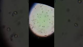 Crenated RBCs in urine under the microscope [upl. by Anirdna825]