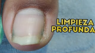 😬Como yo realice una Limpieza Profunda de las Uñas de los Pies🦶 Embelle Ser ojo aprendiendo uñas [upl. by Attenat971]