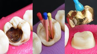 Classic Restoration Of Decayed Tooth By Root Canal And Gold Crown [upl. by Olimpia505]