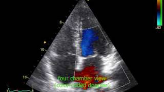 echocardiography with sound and arrhythmia [upl. by Iahcedrom788]