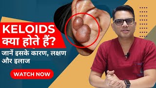 What are the Keloids  Keloid Treatment in Delhi  Best Skin Clinic Delhi  SkinQure  Dr Jangid [upl. by Chow]