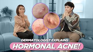 How to Treat CYSTIC amp HORMONAL ACNE Derma Answers Medications Causes Lifestyle etc Filipino [upl. by Frederica]